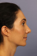 Rhinoplasty