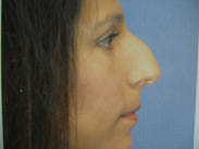 Before Eva's Rhinoplasty